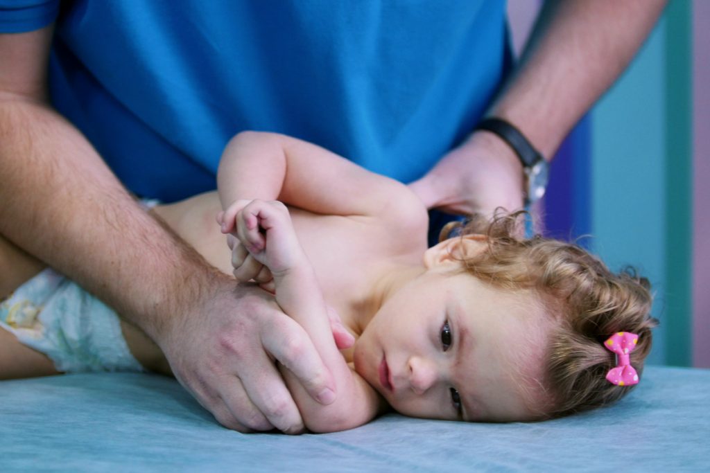 Arthrogryposis