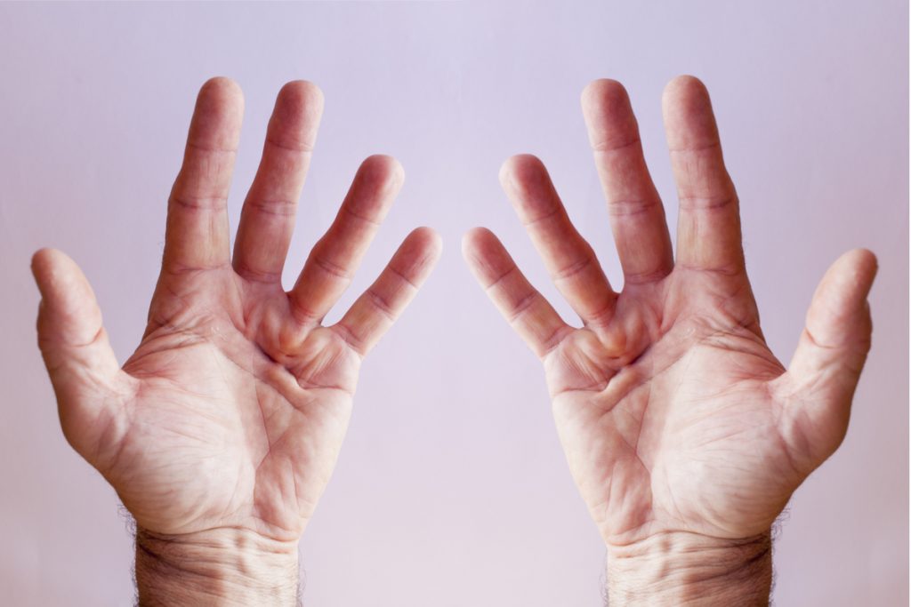 Dupuytren disease