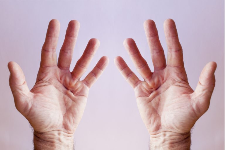 Dupuytren’s disease