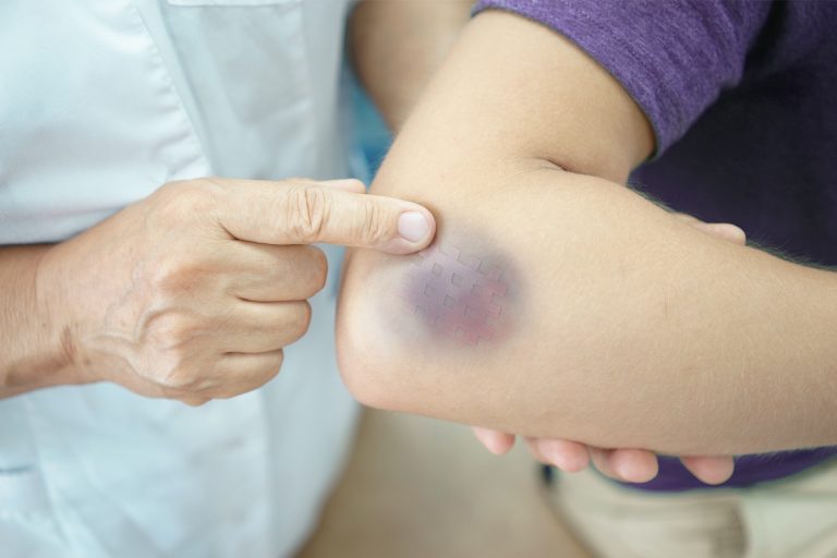 Hematoma
