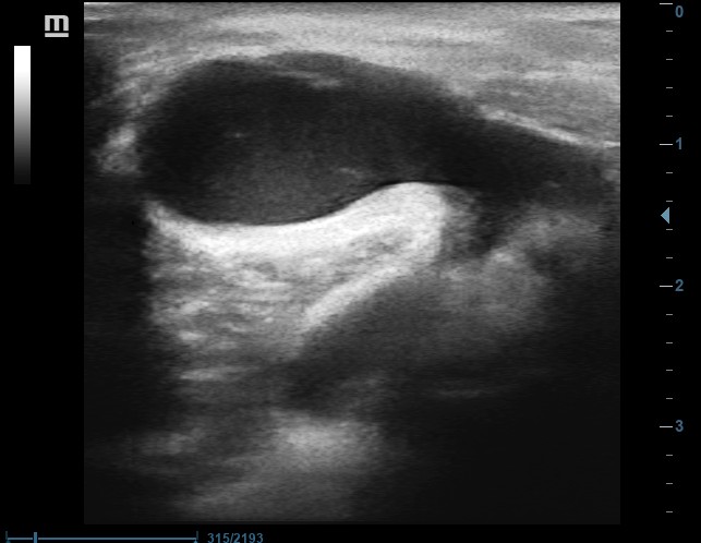 Baker cyst – bursa, recesus or a true cyst?
