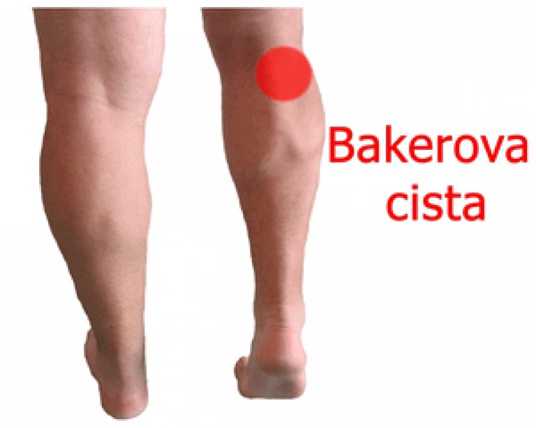 Baker’s cyst – popliteal cyst