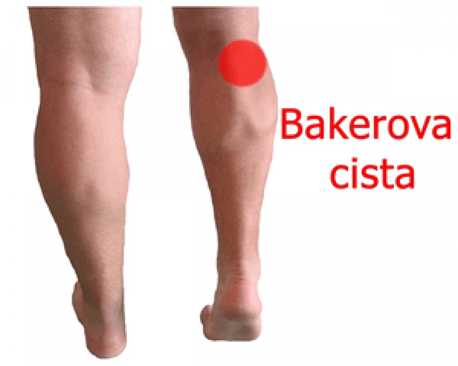 Baker's cyst