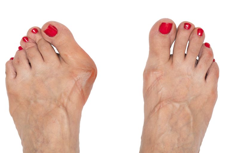Hallux valgus – foot thumb deformity