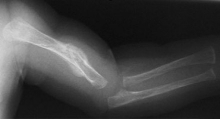 Osteogenesis imperfecta