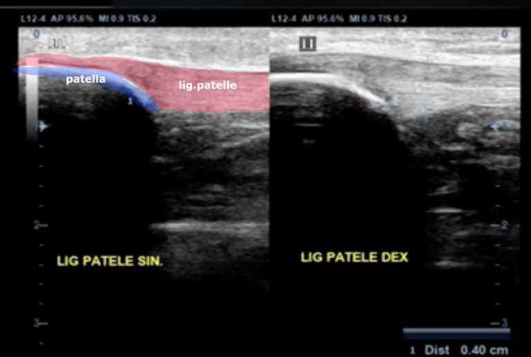Patela