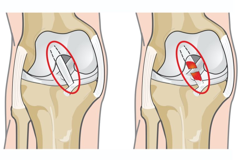 Rupture of the anterior cruciate ligament – ACL rupture