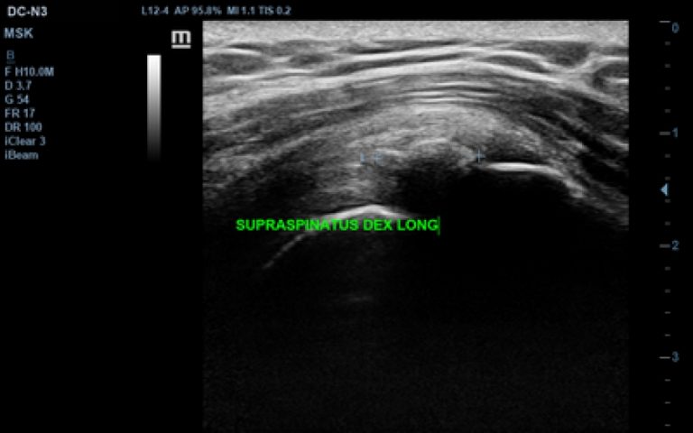 supraspinatus calcification-