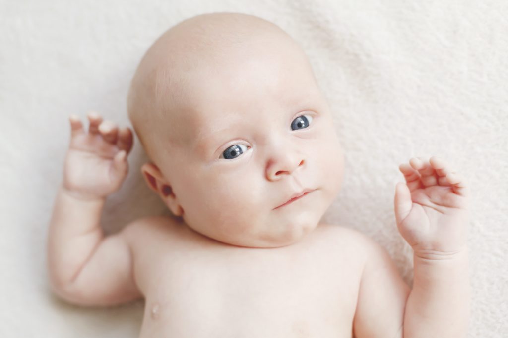Torticollis